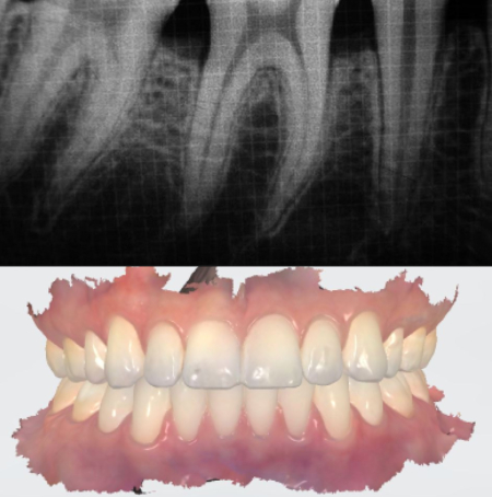 Dental X-rays