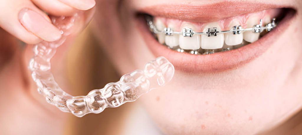 Orthodontic Treatment