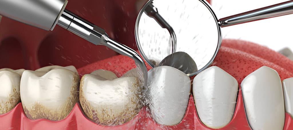 Scaling and Polishing