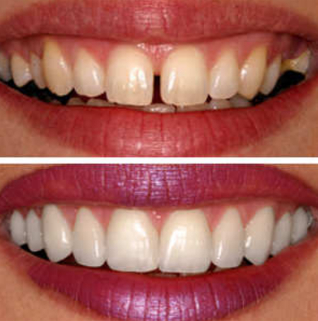 Smile Designing (Veneers)