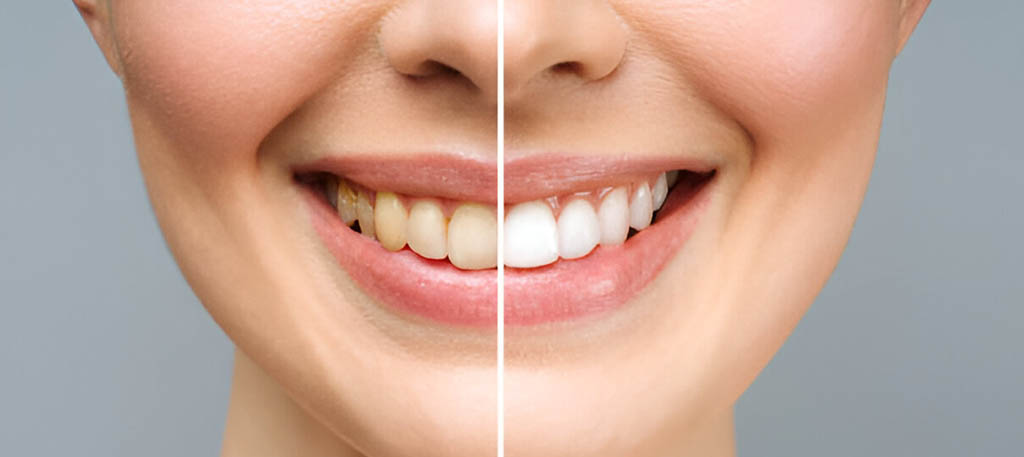 Teeth Whitening